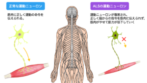  ALSの原因は何ですか？